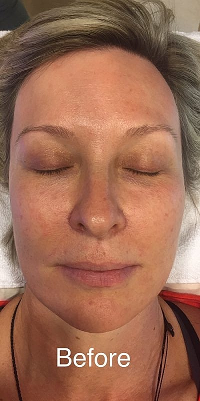 Woman's face before skincare treatment, eyes closed.