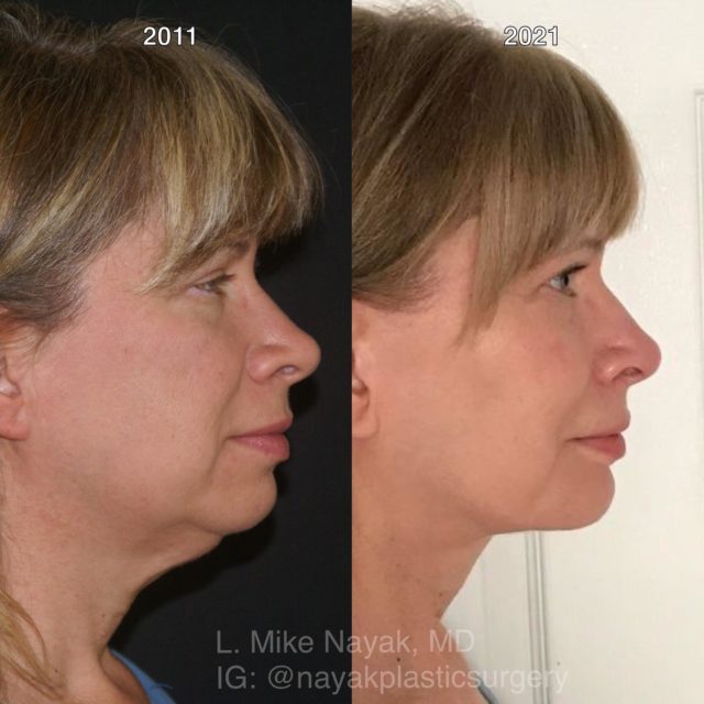 St Louis Lip Filler Before And After Photos Des Peres Plastic Surgery Photo Gallery Avani Derm Spalip Filler Archives Nayak Mike Avanidermspa Com